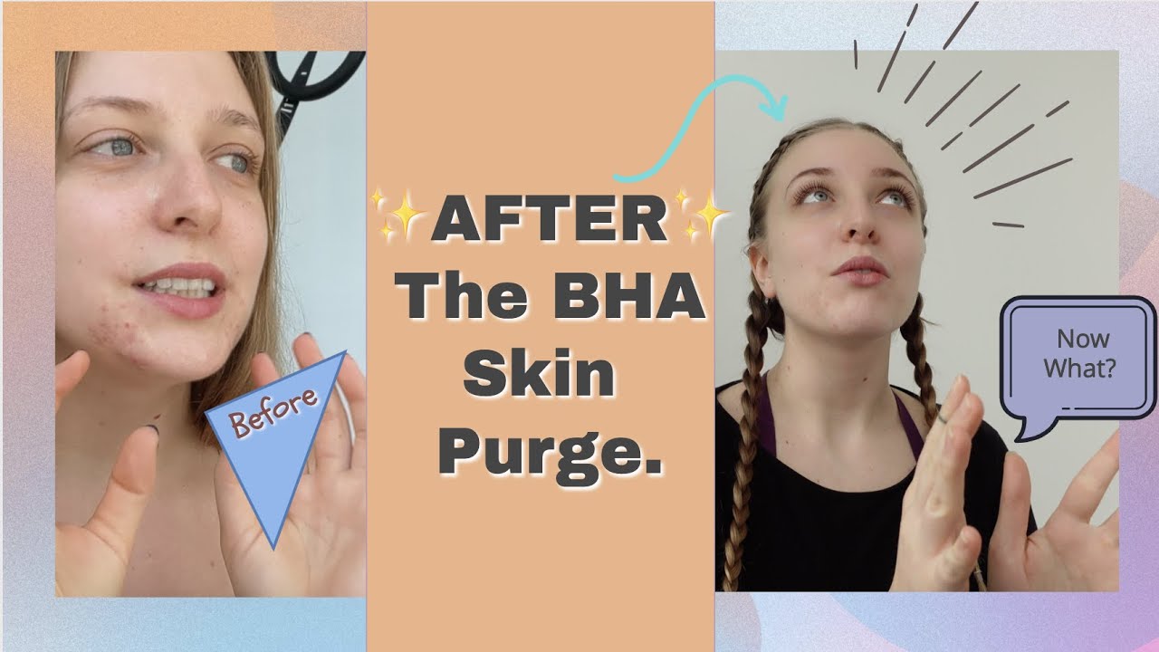 BHA Salicylic Acid Part 4: After Skin Purging | Healing Scars ...