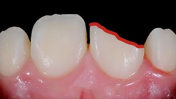 Trám răng cửa bị gãy bằng composite | Composite restoration fillings #Shorts