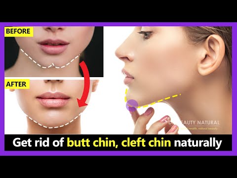 How to get rid of butt chin, cleft chin, chin dimples naturally. Make smooth and rounded chin shape.