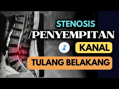 Video: Mana spondilosis atau stenosis yang lebih buruk?