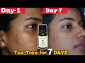 7 days clear skin challenge  tea tree oil for face  ravinaa gupta