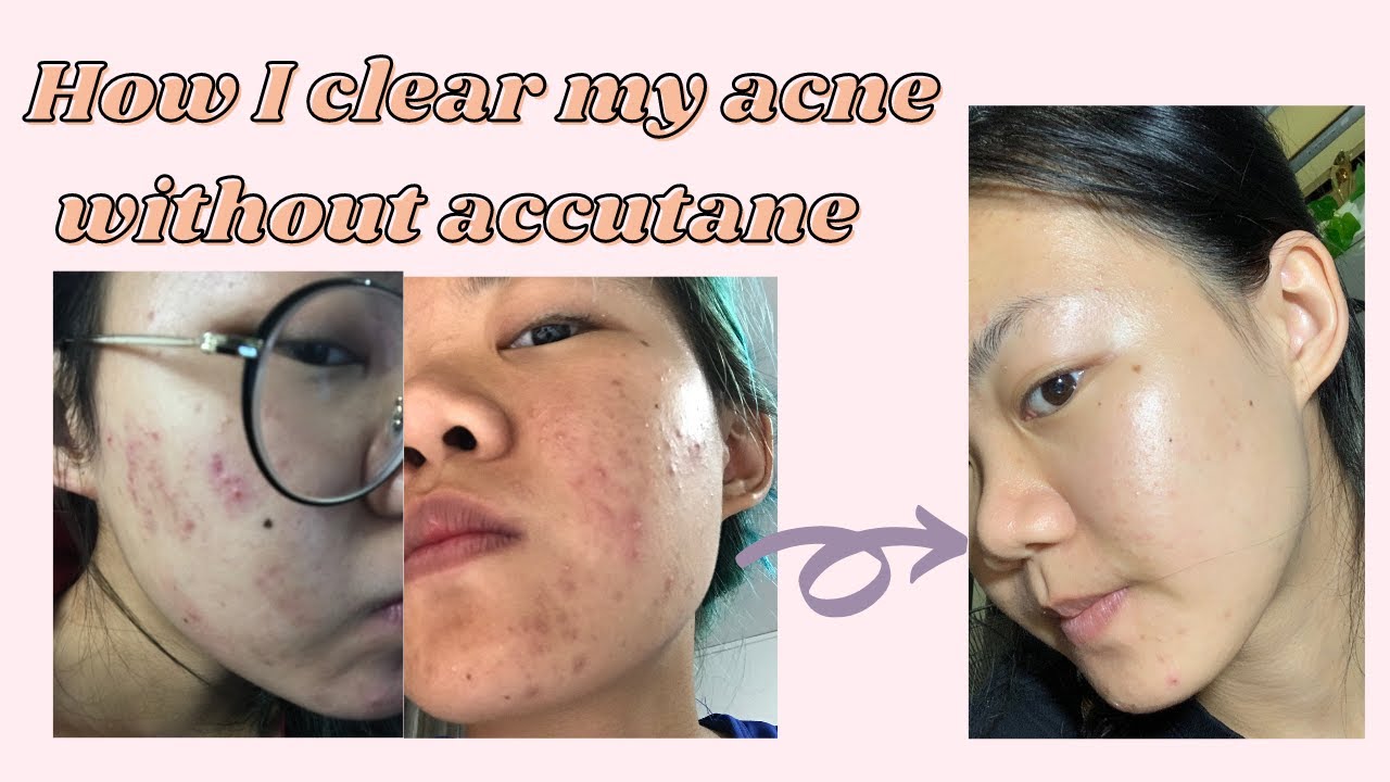 How I got rid of my Cystic Acne & pimples with Eighteen Vitaskin ...