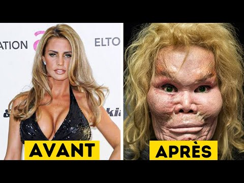 20 fois que la chirurgie plastique a horriblement  Viré au Cauchemar !