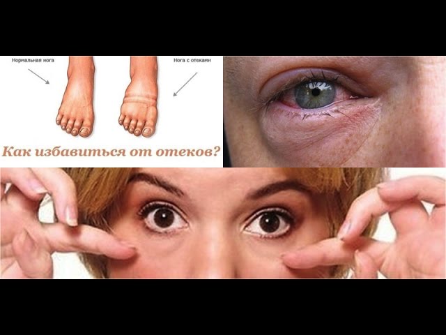 Отеки от недосыпа. Отеки от недосыпа. Мешки под глазами. Почему у алкоголиков мешки под глазами. Отеки от недосыпа.