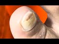 Ep_6547 Toenail removal 👣 เล็บ 2 ชั้น 😄 (clip from Thailand)