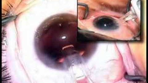 cataract surgery IOL insertion Uday Devgan MD lens implant