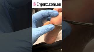 Painful Corn And Callus Cut From The Foot Of A Patient By A Podiatrist