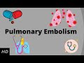 Pulmonary embolism, Causes, Signs and Symptoms, Diagnosis and Treatment.