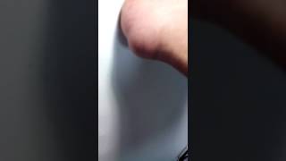 Achilles Reconstruction Of Haglands Deformity And Bursa 1