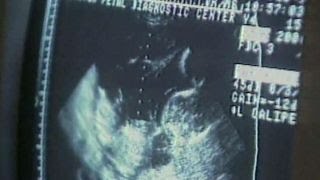 Ohio legislation would ban abortion on fetus with Down syndrome