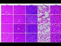ML-Based Techniques for the Prediction of Axillary Lymph Node Metastases in Early Breast Cancer.