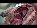 19.婴尸检查教学 中山大学 法医病理学  Forensic Anatomy of Baby Corpse