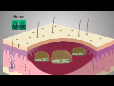 Vídeo: Epigalocatequina-3-galato Oral Para El Tratamiento De La Epidermólisis Ampollosa Distrófica: Un Ensayo Clínico Multicéntrico, Aleatorizado, Cruzado, Doble Ciego, Controlado Con Pla