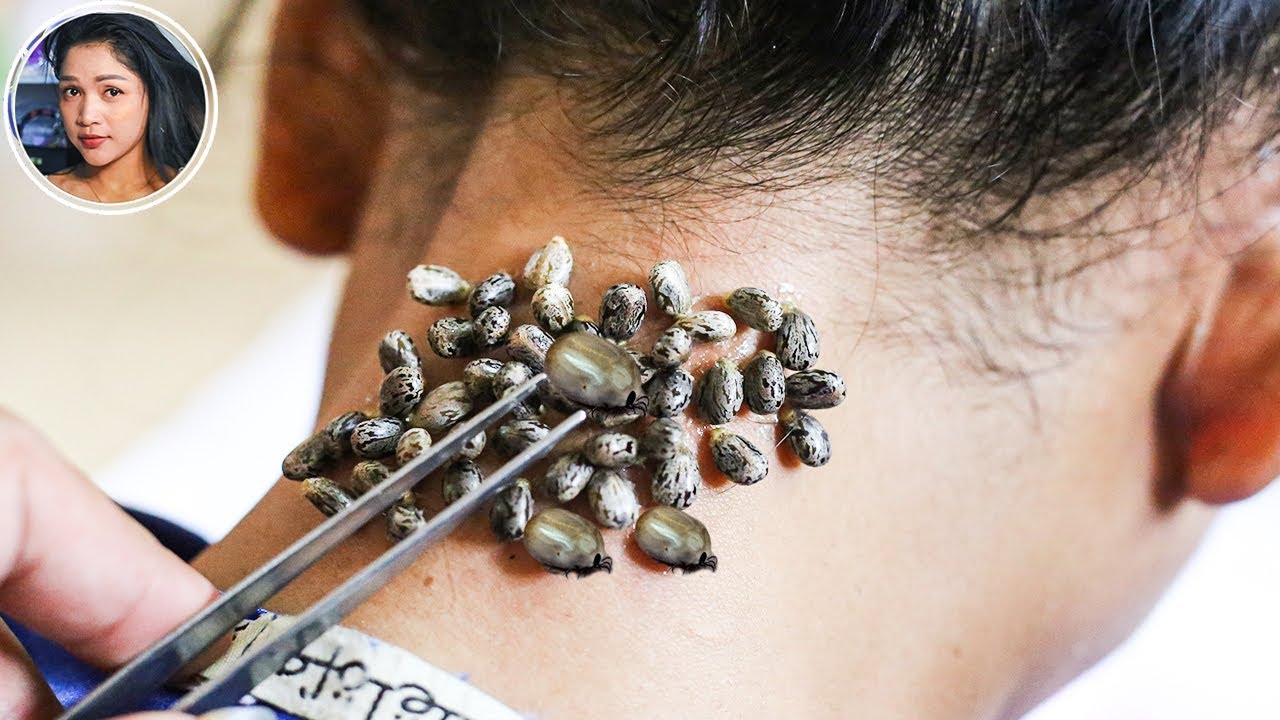 Why Million Giant Ticks is Living on Poor Girl's Neck ? 296 YouTube