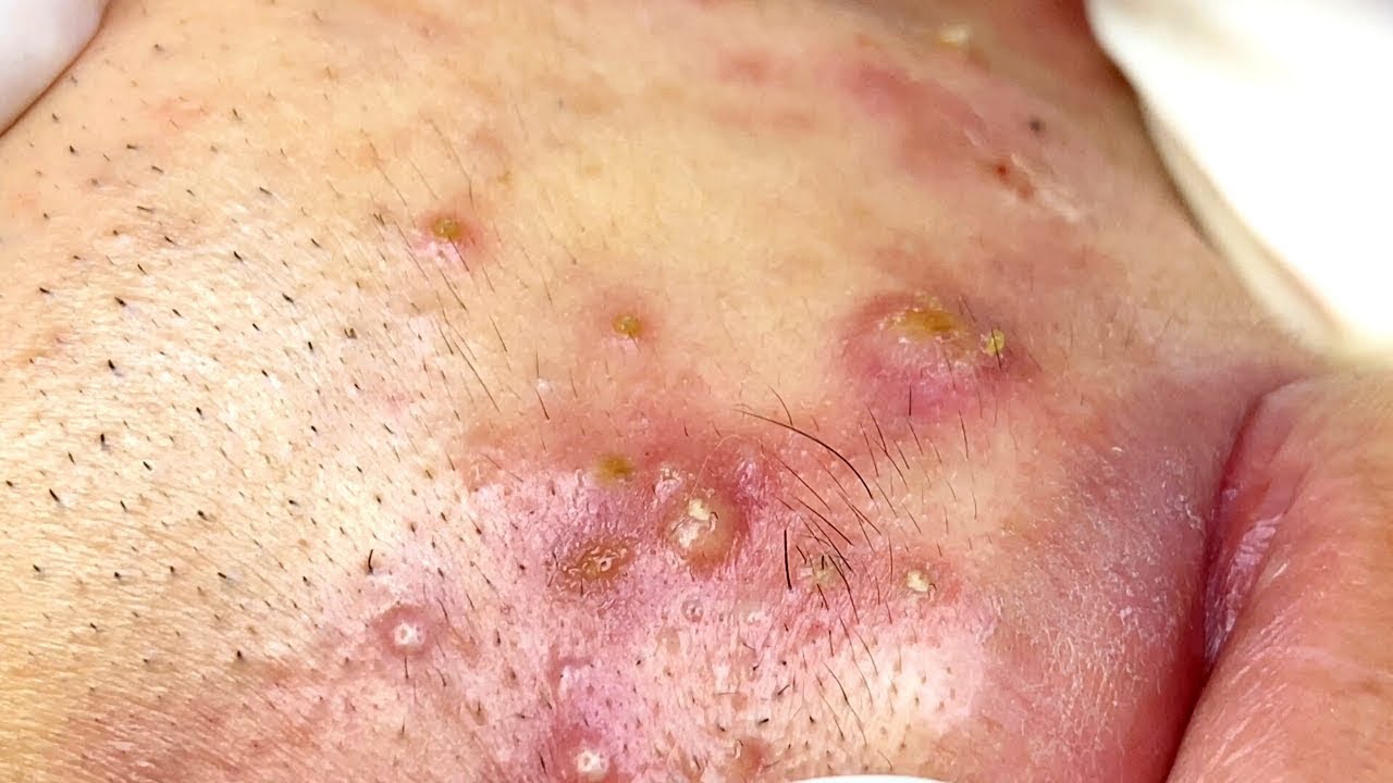 Astonishing Loan Nguyen Blackheads