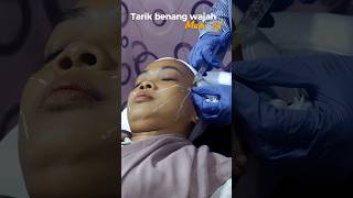 Tirus dengan tarik benang wajah /  threadlift