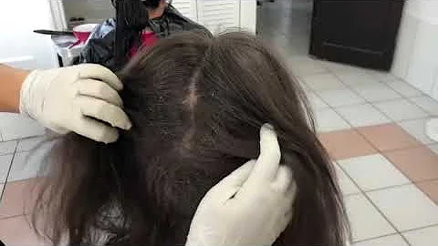 ¿Es posible tener liendres muertas en el pelo?