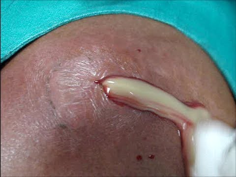 Large abscess ( pus ) drainage