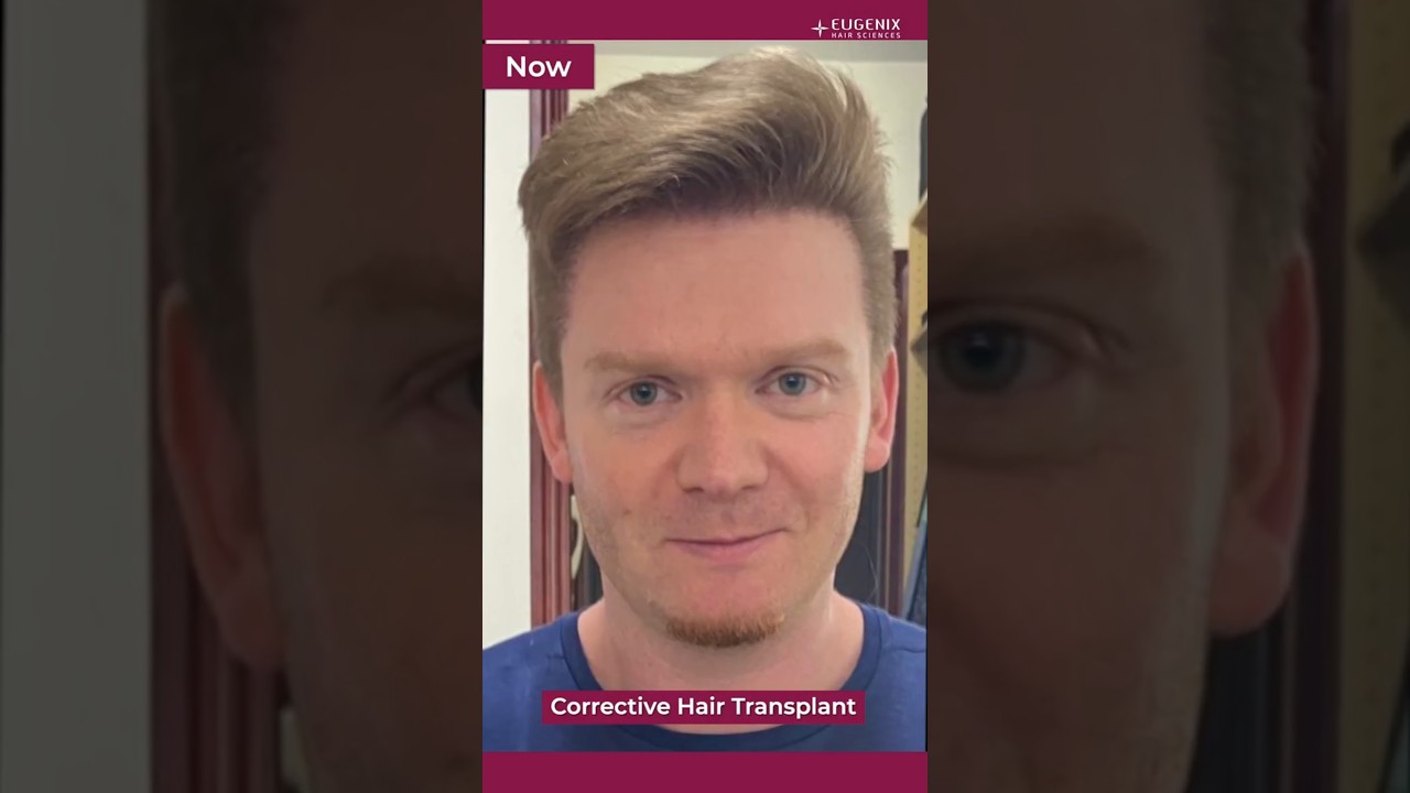 Corrective Hair Transplant: Fixing the Past, Framing the Future.