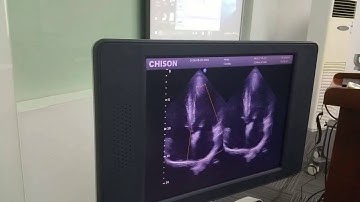 New Qbit 5 scanning  cardiac under BBC mode