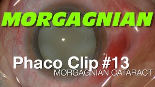 Phaco Clip #13 - Morgagnian Cataract