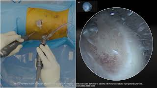 AutoCart™ Technique for a Cam Delamination Lesion @WhatsNewinOrthopedics