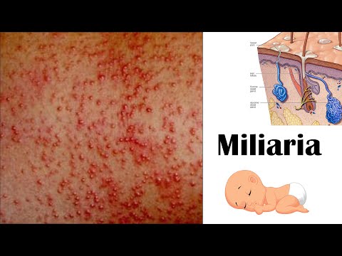 Video: Vai miliaria var inficēties?