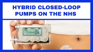 HYBRID CLOSED LOOP INSULIN PUMPS ON THE NHS?! - T1D NEWS UPDATE