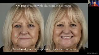 Study Club Live 4 Restoring Jan’s Smile: Complete Dentures Inspired by Her Daughter - Finlay Sutton