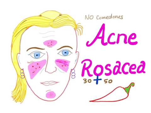 Acne Rosacea