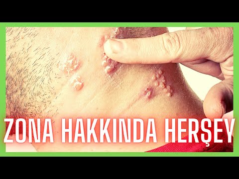 Zona Hastalığı Hakkında