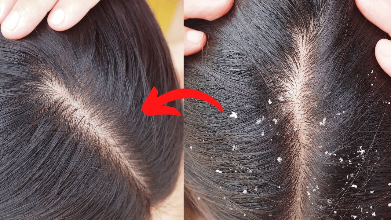 🔥1 HOW TO TREAT DANDRUFF AT HOME How to get rid of Dandruff