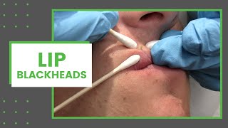 Lip Blackheads | Dr. Derm