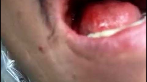 Preciaion attachment partial denture. Part 1