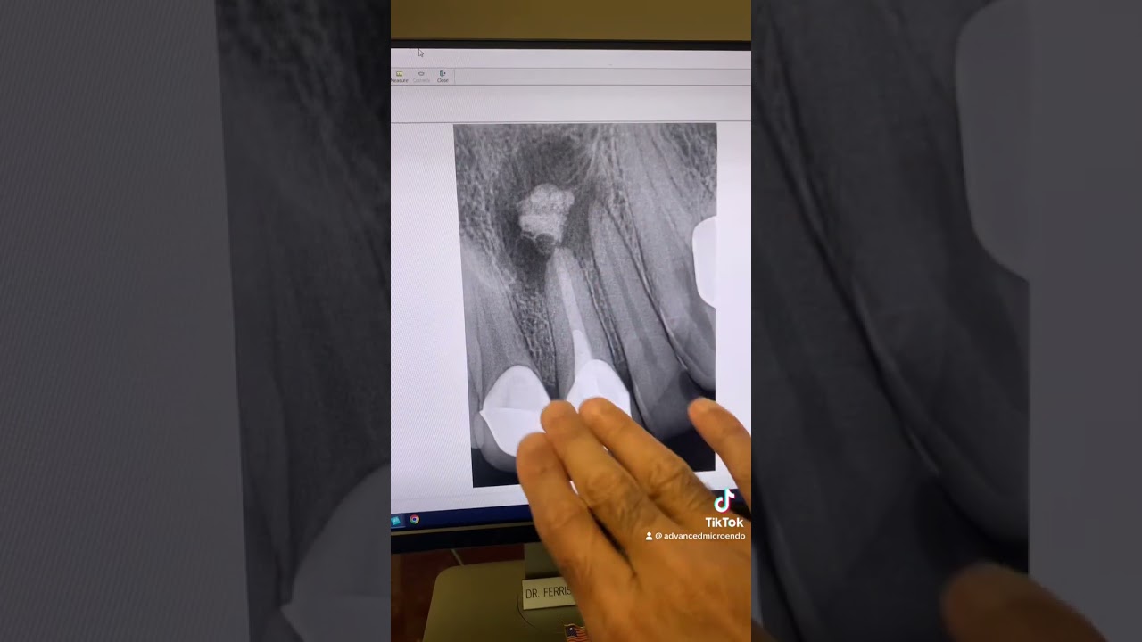 One appointment endodontic retx of tooth #9 & I extruded MTA out the canal!