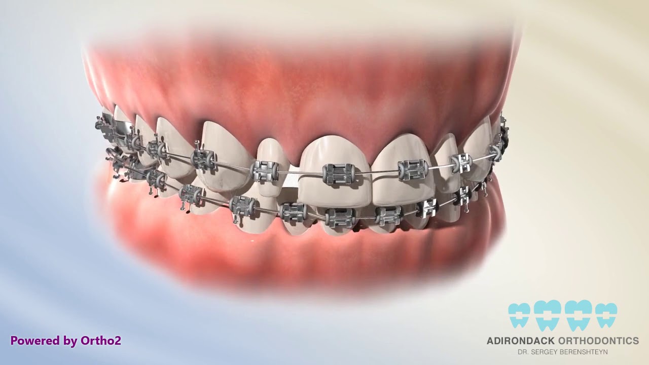 Veneer for small teeth