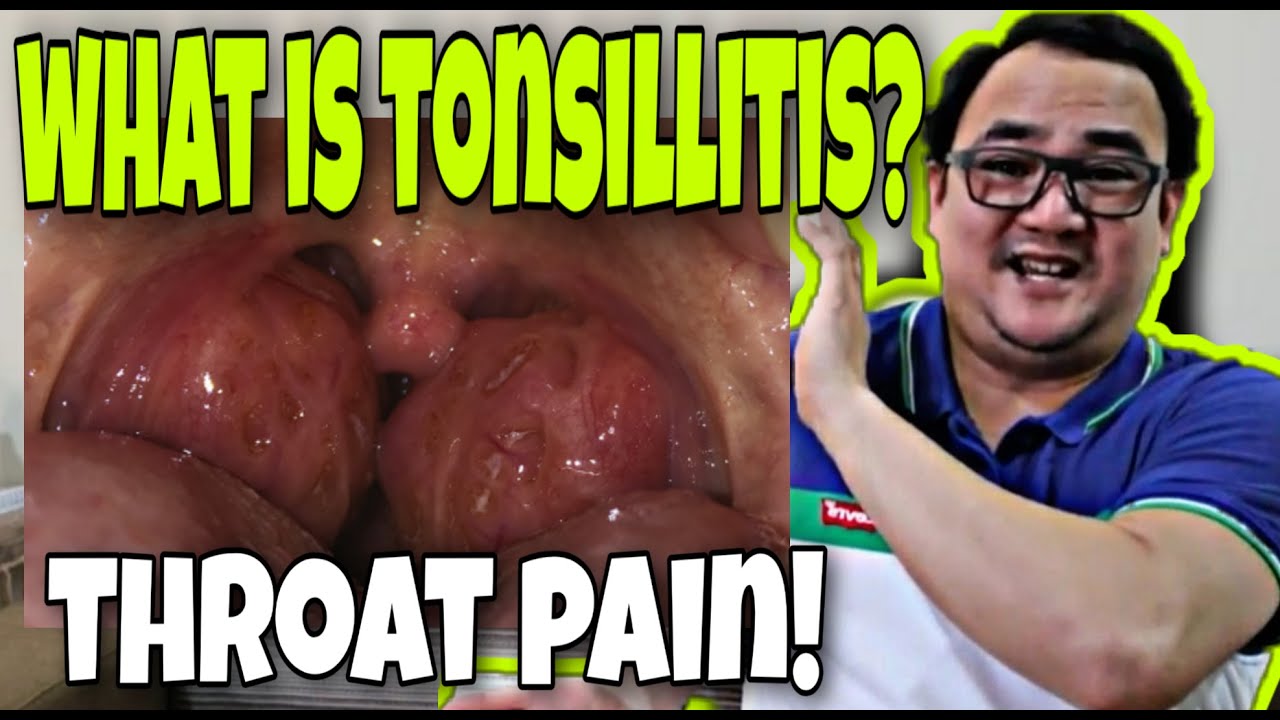 What Is Tonsillitis Youtube