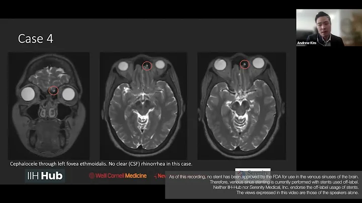 CSF Leaking and Idiopathic Intracranial Hypertension (IIH) with Andrew Kim, MD