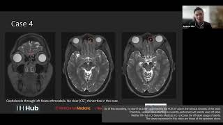CSF Leaking and Idiopathic Intracranial Hypertension (IIH) with Andrew Kim, MD