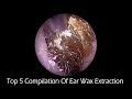 Top 5 Compilation Of Ear Wax Extraction With Relaxing Music and Natural Forest Background