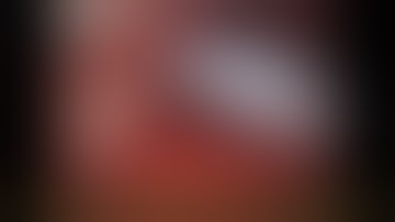 Robot assisted VEIL (Video Endoscopic Inguinal Lymphadenectomy)