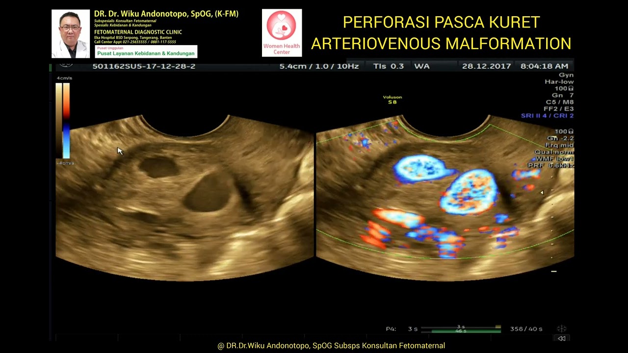 Perforasi pasca kuretase