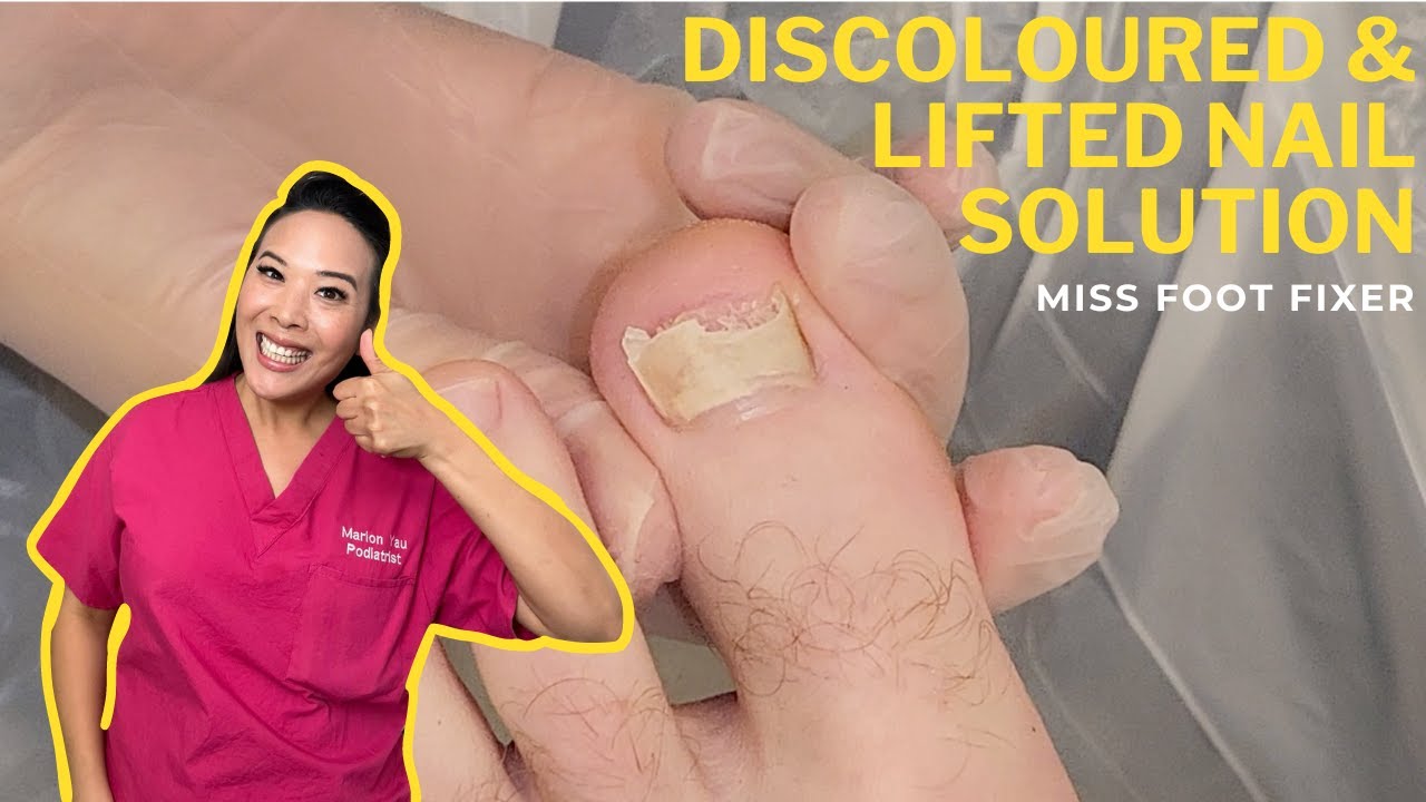 How To Treat Discolored & Lifted Toenails: Expert Tips For Healthy ...
