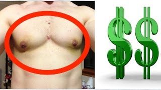 Gyno surgery - How much should it cost?