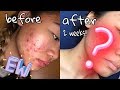 Aztec Secret Indian Healing Clay Review!! (2 weeks)