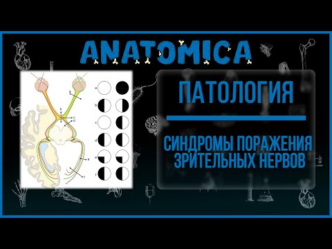 Синдромы поражения зрительных нервов / Патология