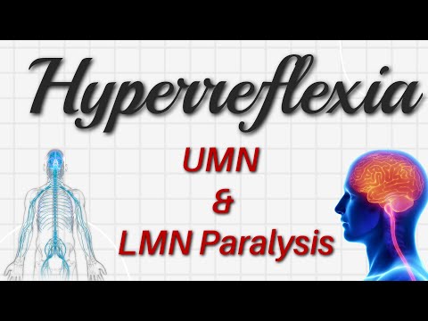 Hyperreflexia - Deep Tendon Reflex Knee Jerk Reflex #paralysis #Hemiparesis #brain #spine #injury
