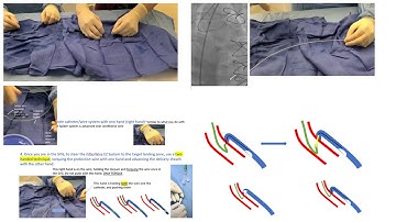 Vein graft PCI: Focus on distal embolic protection-how, when, pitfalls, troubleshooting- Elias Hanna