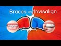 Battle of the Brands: INVISALIGN VS BRACES