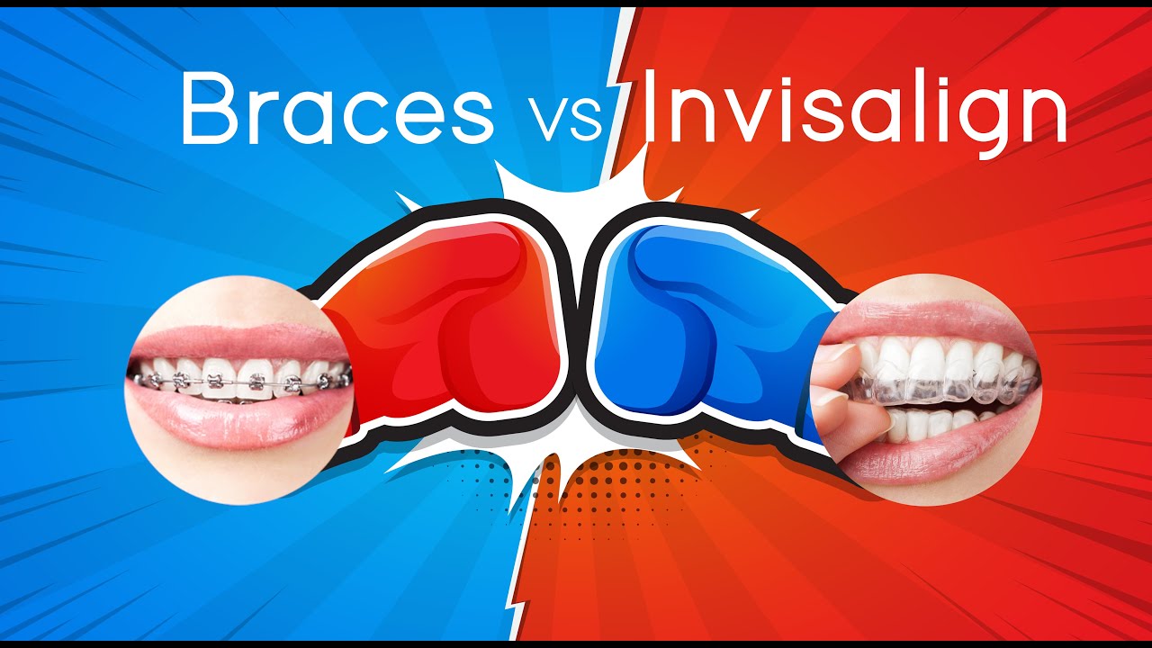 Battle of the Brands INVISALIGN VS BRACES YouTube